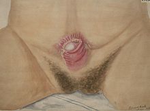 Watercolour drawing of ectopia vesicae in a man aged 23 years, after operation Ectopia vesicae in a man aged 23 years Wellcome L0062460.jpg