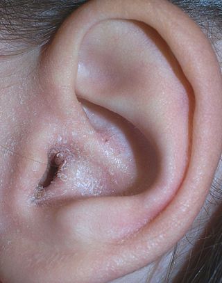 <span class="mw-page-title-main">Ear eczema</span> Medical condition