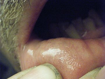 Serpentine path of Gongylonema pulchrum in the lip mucosa of a man [1]