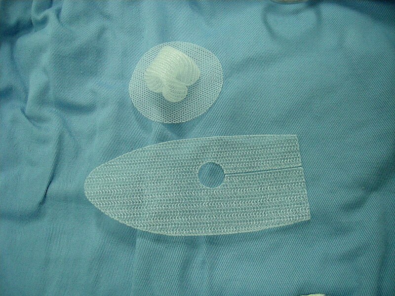 Picture of Hernia Mesh in Relation to Hernia Mesh Recalls 