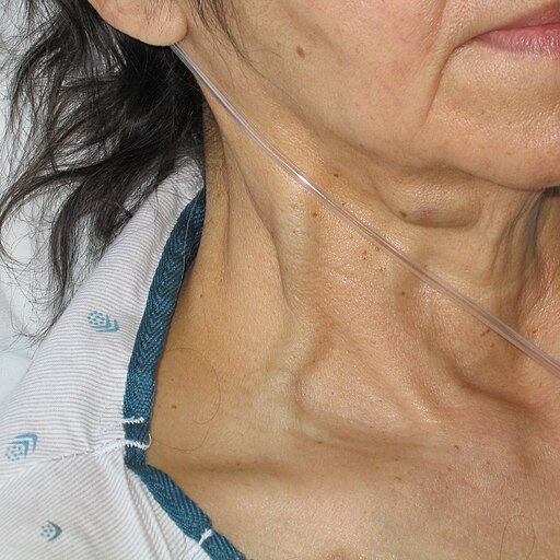 Jugular Venous Distention (JVD)