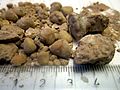 Kidney stones ( renal calculi ), Бубрежни камења 7.JPG