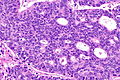 Kidney metastasis - high mag.