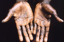 Mpox - palms (1997)