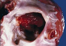 A myxoma. A gelatinous tumor can be seen attached by a narrow pedicle to the atrial septum. The myxoma has an irregular surface and nearly fills the left atrium. Myxoma.jpg