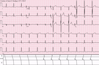 Wandering atrial pacemaker it is an atrial arrhythmia that occurs when the natural cardiac pacemaker site shifts between the sinoatrial node, the atria, and/or the atrioventricular node.