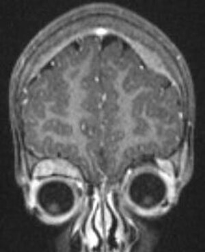 Neuroblastoma mets.JPG