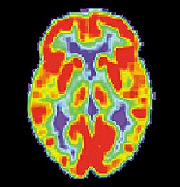 Brain positron emission tomography (PET) scan PET Normal brain.jpg