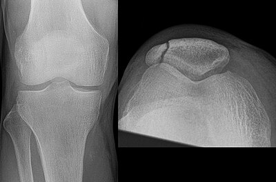 Перелом надколенника. Перелом надколенника рентген. Остеохондральный перелом надколенника. Оскольчатый перелом надколенника.