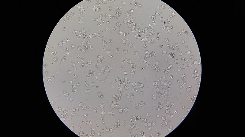 File:Plenty of pus cells in Urine Microscopy.jpg