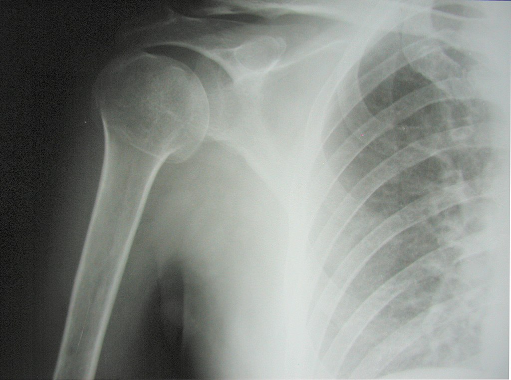 File:Surgical neck fracture of humerus.jpg - Wikimedia Commons