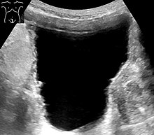 Ultrasound of the urinary bladder