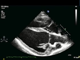 File: xenotrapianto-di-cardiomiociti-umani-cellule-progenitrici-non-migliora-funzione-cardiaca-in-a-pone.0143953.s010.ogv