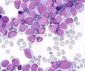 Thumbnail for Acute myeloid leukemia