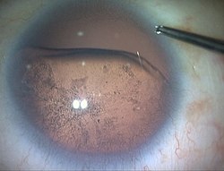 Fig 7A : Case with aniridia (no iris) glaucoma (increased pressure in the eye) and subluxated cataract. Aniridia glued IOL A.jpg