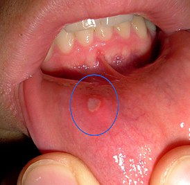 Проявление афтозного стоматита на нижней губе