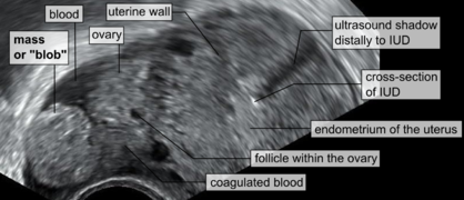 A "blob sign", which consists of the ectopic pregnancy. The ovary is distinguished from it by having follicles, whereof one is visible in the field. This patient had an intrauterine device (IUD) with progestogen, whose cross-section is visible in the field, leaving an ultrasound shadow distally to it.