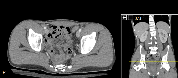 CT of a normal abdomen and pelvis, axial plane 236.png