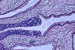 צילום מיקרוסקופי של דגימה היסטולוגית של קרצינומה בצוואר הרחם