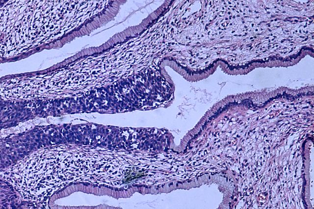 Light microscope image of the cervix, showing normal epithelium (right) and carcinoma in situ (left), a pre-cancerous precursor to cervical cancer