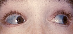 Characteristically blue sclerae of patient with osteogenesis imperfecta.jpg