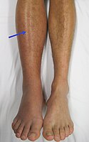 Deep vein thrombosis of the right leg.jpg