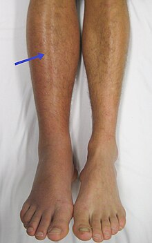 A right-sided acute deep vein thrombosis (to the left in the image). The leg is swollen and red due to venous outflow obstruction. Deep vein thrombosis of the right leg.jpg
