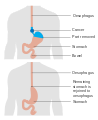 Diagram showing before and after an oesophago-gastrectomy CRUK 107.svg
