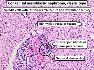 Histopathology of congenital mesoblastic nephroma.jpg
