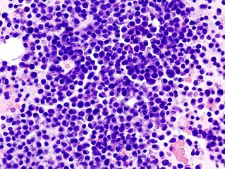 Bone marrow aspirate showing the histologic correlate of multiple myeloma under the microscope, H&E stain