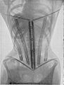Fig. 32. — Padiographie du corset cambré devant (devant).