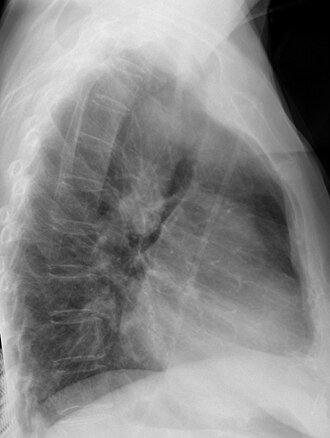 Chest radiograph showing a right-sided aortic arch, lateral view Rechts descendierende Aorta - Roe seitlich.jpg