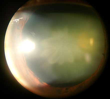Post traumatic rosette cataract