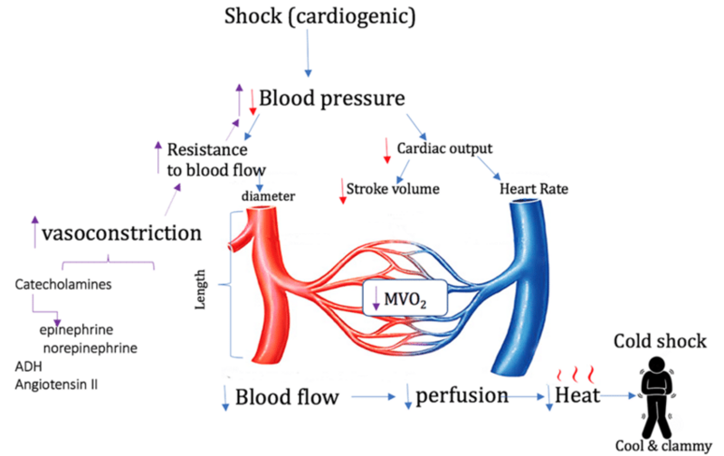 File:Simplified scheme of cardiogenic shock.png