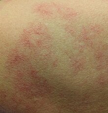 Multiple spider angiomas SpiderAngioma.jpg