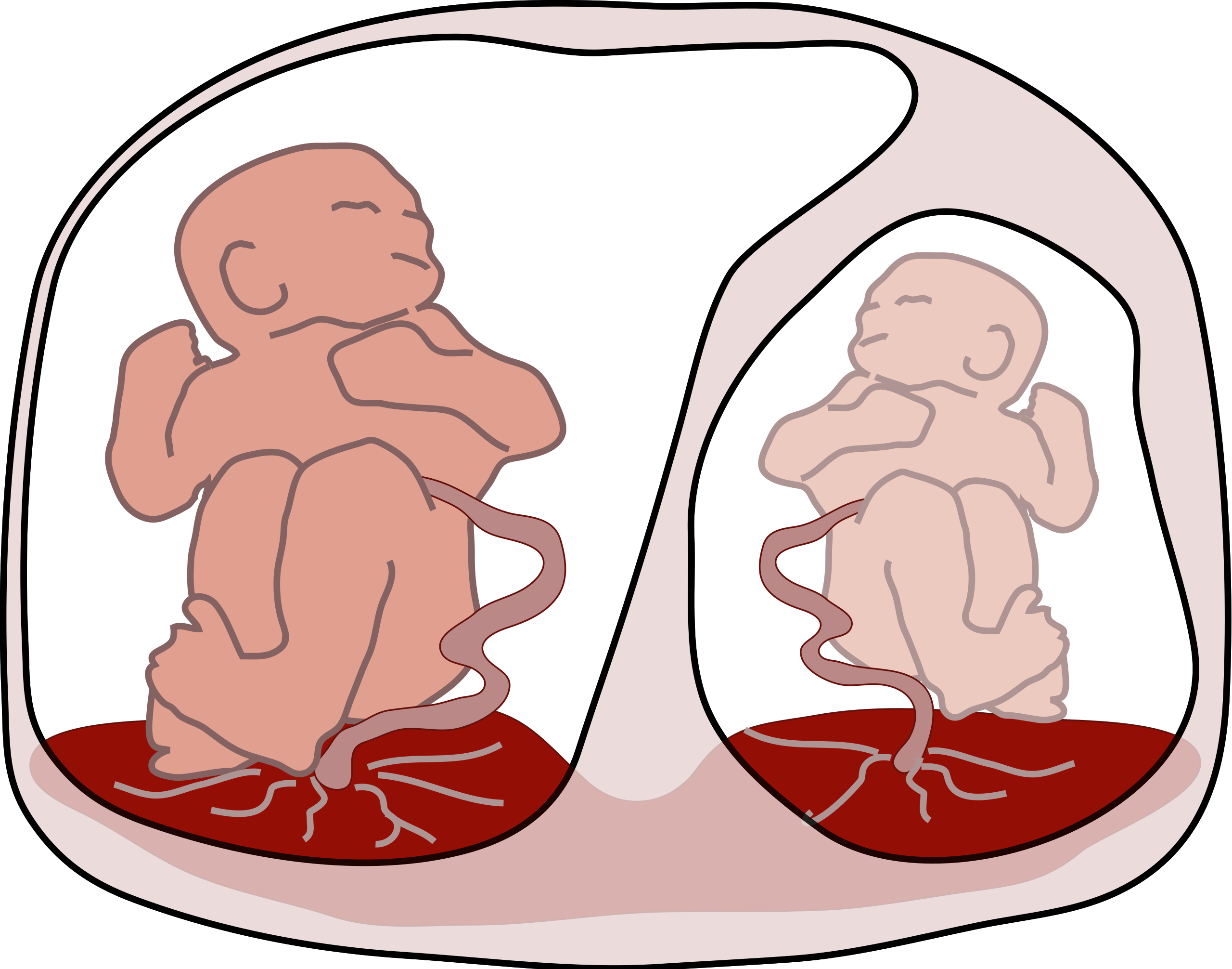 File:Twin to Twin transfusion syndrome.svg.