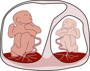 Syndrome de transfusion jumelle à jumelle.svg