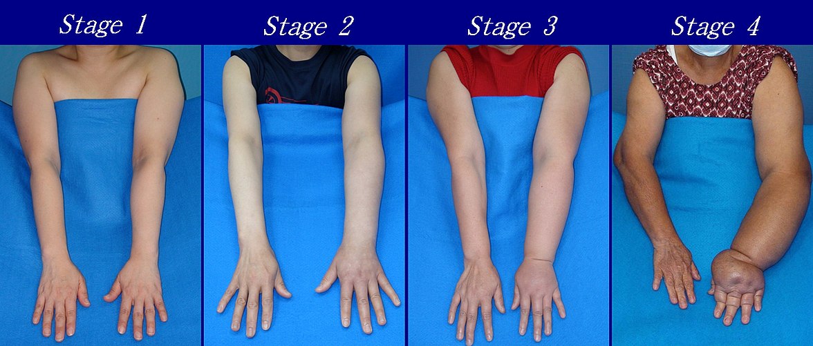 Severity of upper extremity lymphoedema in different stages