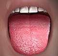 Xerostomia - Dry Mouth.jpg