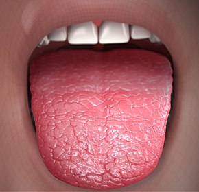 Xerostomia - Dry Mouth.jpg 