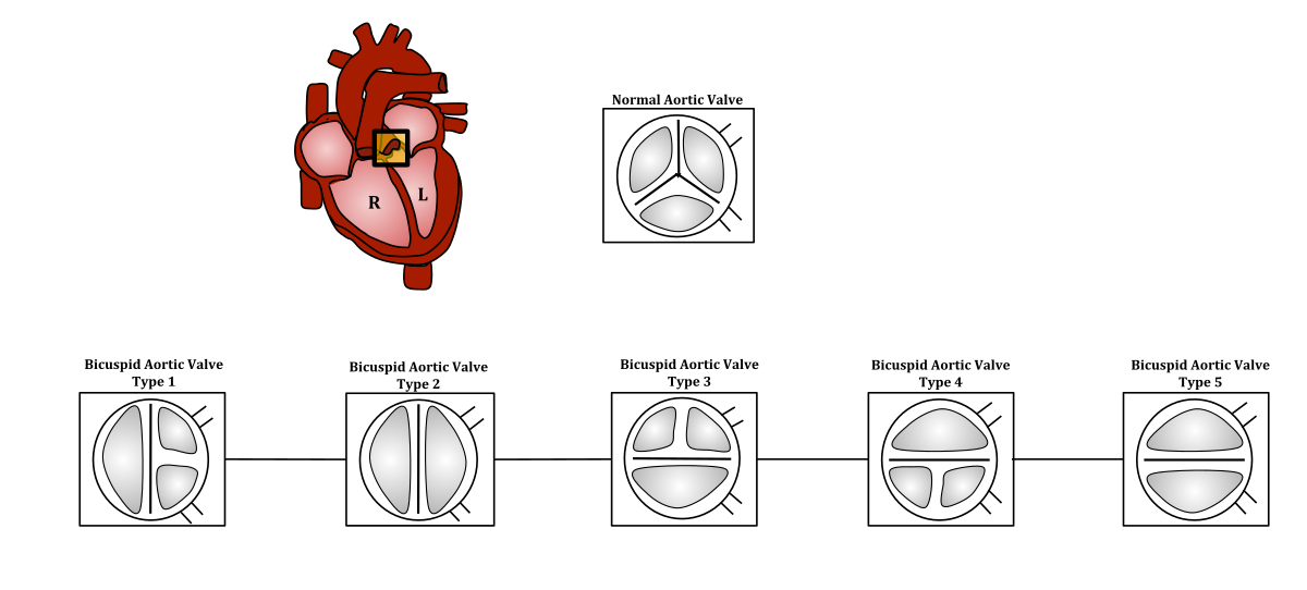 Aortic Valve Size Chart