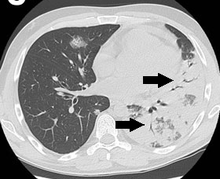 CT scan of air bronchograms in a case of legionnaires' disease. CT with consolidations with air bronchograms in legionnaires' disease.png