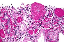 Micrograph of the collapsing variant of FSGS (collapsing glomerulopathy). A collapsed glomerulus is seen at the top, right-of-centre. PAS stain. Kidney biopsy. Collapsing glomerulopathy - very high mag.jpg