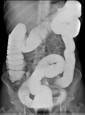 Dolichocolon case 1 8.jpg