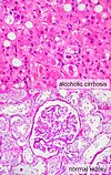 Pathology image of alcoholic cirrhosis, the most common cause of HRS