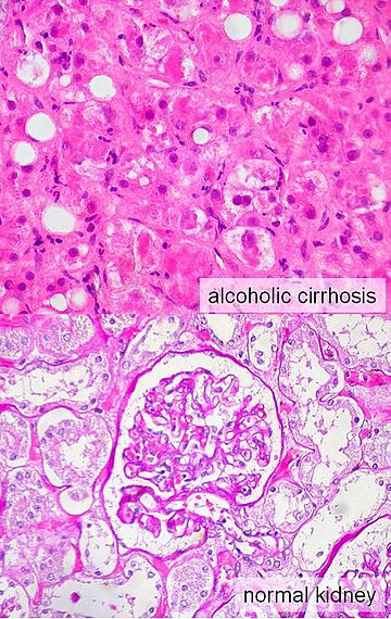 Hepatorenal sindrom