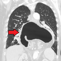 CT所看到的巨大食管裂孔疝影像