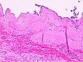 Histopatholgoy of acute gangrenous cholecystitis.jpg