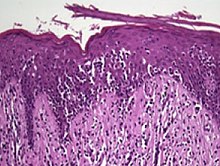 Histopathology of Pautrier microabscesses in cutaneous T cell lymphoma. Histopathology of Pautrier microabscesses.jpg