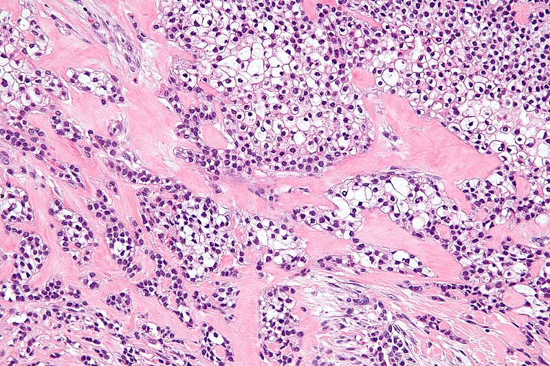 File:Hyalinizing clear cell carcinoma - high mag.jpg